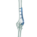Distal-Humerus-Lateral-Anatomik-Plak1-600×450