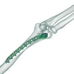 Distal-Humerus-Posterolateral-Anatomik-Plak1-600×450