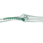 Distal-Humerus-Posterolateral-Anatomik-Plak2-600×450